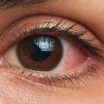 नसर्ने रोगका कारण आँखाको समस्या बढ्ने नेपालमा गरेको अध्ययनको निष्कर्ष