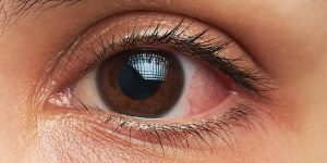 नसर्ने रोगका कारण आँखाको समस्या बढ्ने नेपालमा गरेको अध्ययनको निष्कर्ष