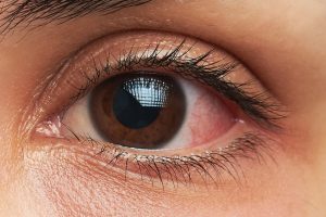 नसर्ने रोगका कारण आँखाको समस्या बढ्ने नेपालमा गरेको अध्ययनको निष्कर्ष