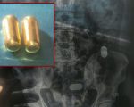 पेटभित्र सुन लुकाएर ल्याउने बंगलादेशी नागरिक पक्राउ